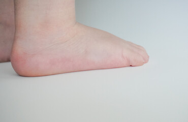 Close-up of a child’s foot with flat arch, side view, on a light background, highlighting the...