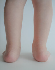Back view of a child’s feet with flat arches, standing on tiptoes, showing heel alignment and leg...