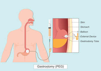 Gastrostomy or PEG Tube.