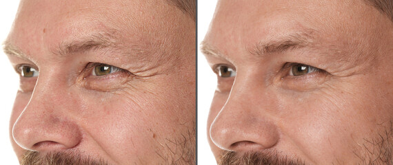Man showing his face before and after skin care treatment, closeup. Collage