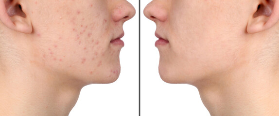 Obraz premium Man with acne problem showing his face before and after skin care treatment, closeup. Collage