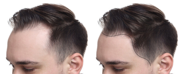 Man before and after hair treatment on white background, collage