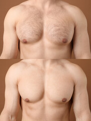 Man before and after hair removal procedure, closeup. Collage showing hairy and smooth chest