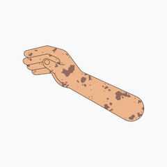 Vitiligo hand arm, gesture flat collage element vector