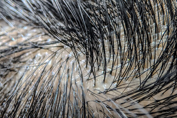 Close-up of human scalp with visible dandruff flakes among hair strands, illustrating dry skin,...