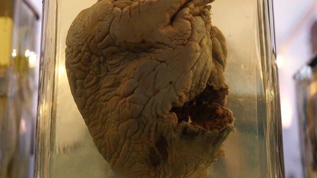 Real human broken heart in formalin due to a massive heart attack. Human anatomy. Zoom in shot
