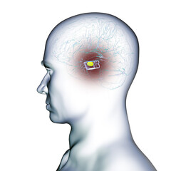 Human brain with degenerated substantia nigra in Parkinson's disease, 3D illustration.