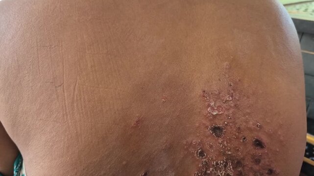 Close up image of skin texture suffering severe urticaria or hives or kaligata in shoulder asian girl. Allergy symptoms, with wounds that partially dry out from eating seafood.