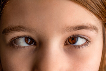 Little patient strabismus, treatment ophthalmic diseases. Female eyes with strabismus. Hypertropia. Strabismus. Closeup part child's face, eyes girl