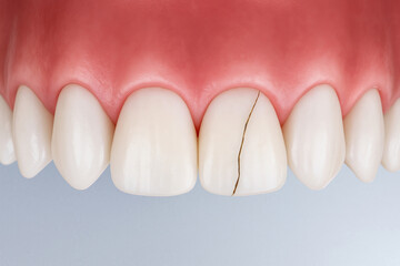 Close-up of cracked front tooth showing enamel fracture line
