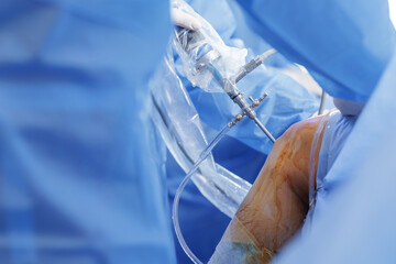 Knee arthroscopy with PCL reconstruction using arthroscope in a sterile operating room