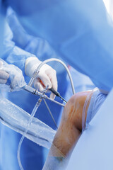 Knee arthroscopy with PCL reconstruction using arthroscope in sterile operating room