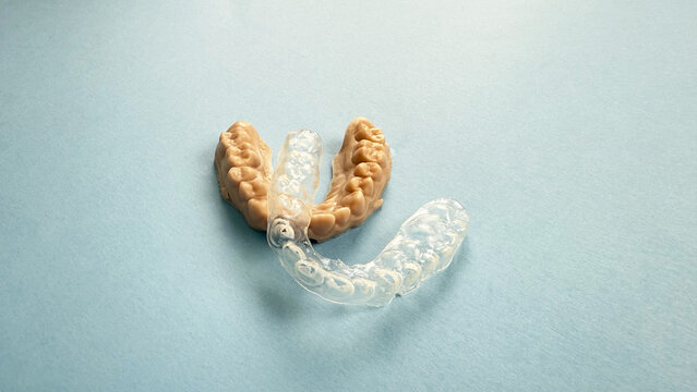 Dental impression of child teeth with transparent worn paediatric mouthguard on blue background, visible scratches and usage marks, female hand holding orthodontic plastic guard for bruxism protection