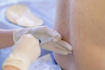 Spinal or epidural injection in lumbar back during sterile hospital procedure close view