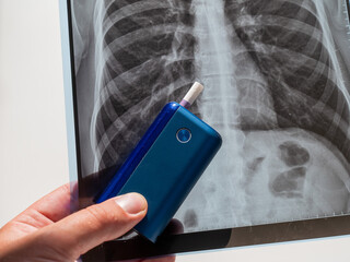 Electronic cigarette and lung x-ray. Tobacco heating system. 