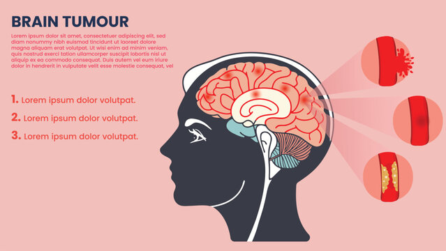 Brain Tumour Surgery Radiation and Latest Therapies Explained