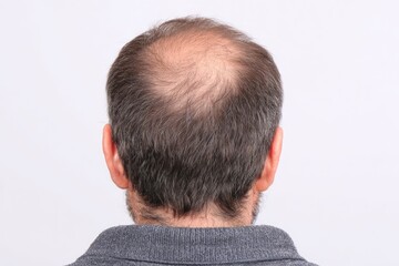 Fototapeta premium Bald spot on man's head, rear view