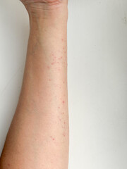 Red spots on the hand. Allergic reaction on the hands.