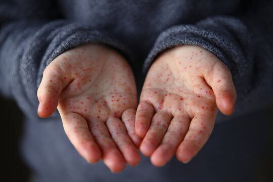 Red spots on the palms, symptoms of hand, foot and mouth disease, enterovirus infection , Generative AI