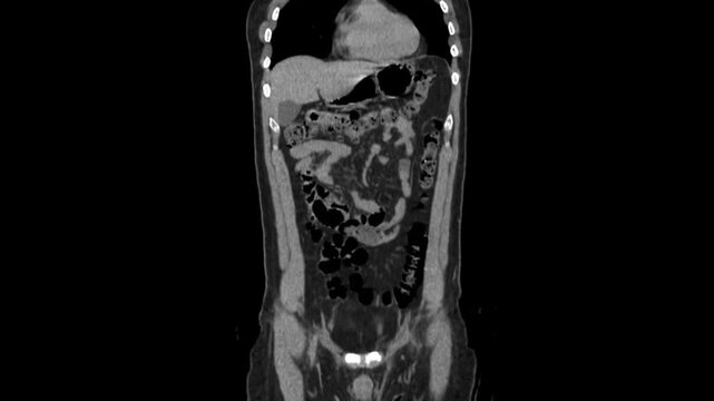 abdomen CT scan 3d rendering showing kidney stone and Dj stent JJ stent (down left) in a urinary system. The stent has been inserted in the patient's ureter to keep it open
