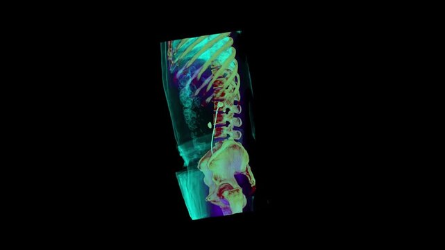 abdomen CT scan 3d rendering showing kidney stone and Dj stent 
