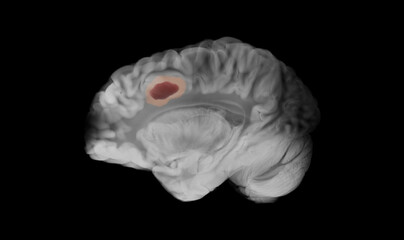 Sagittal view of a human brain in grayscale showing a glioblastoma as a dark maroon mass with a pale pink halo in the left frontal lobe against a black background.