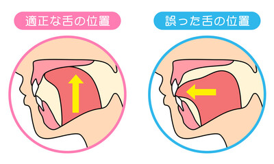 正しいミューイングの方法　適正な舌の位置と誤った舌の位置 © koti