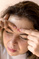 Fototapeta premium Close-up of a young woman’s face while squeezing a pimple. Captures real skin imperfections and acne treatment routine. Suitable for beauty, dermatology, and lifestyle visual content.
