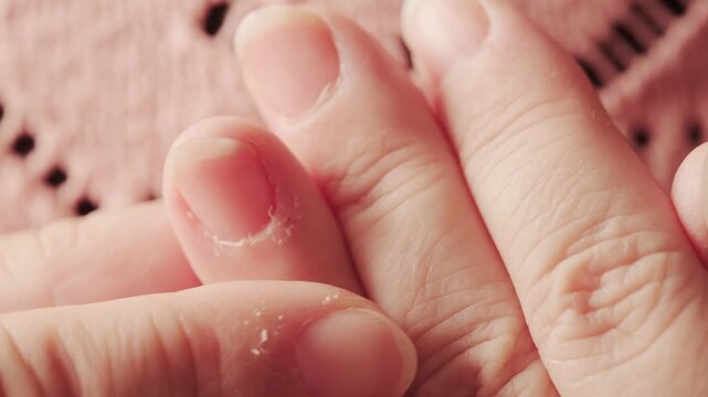 hangnails on fingers, skin scrap, area of ​​exfoliated epidermis surrounding nail, Compulsive nail and cuticle biting, Stress relief or self-harm, obsessive-compulsive disorder, mental health