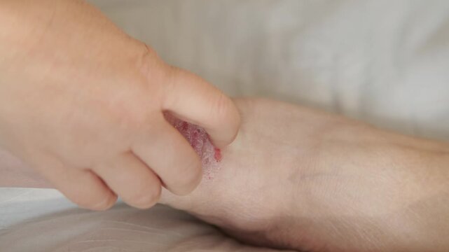 wound from on lower leg with scars of adult female patient, rash, hives, itchy skin, inflammation and allergy, disease on body female patient, Dermatology and Skin Issues, health care