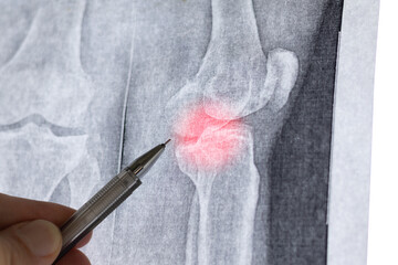 Doctor learn X-ray of knee joint with osteoarthritis. Subchondral sclerosis of the articular...