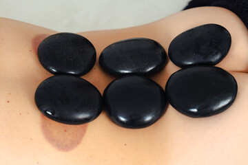 Close-up view of smooth black hot stones arranged on the bare back of an unrecognizable person...