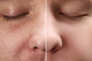 Before and after collage. Photo of man divided in halves showing different skin condition, closeup