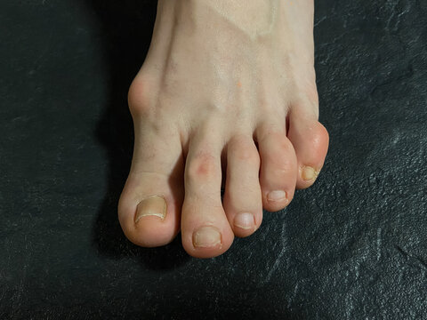 Bony protrusion on female foot, close-up. Swollen Bunion or Painful bunion. Hallux abducto valgus (HAV). Disease leg bones and joints. Toenail fungus or Fungal nail infection