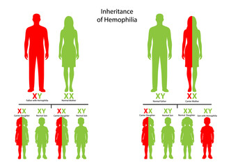 Hemophilia Inheritance Pattern Diagram – X-Linked Genetic Disorder. Medical Illustration of Hemophilia Transmission in Families. Genetic Chart