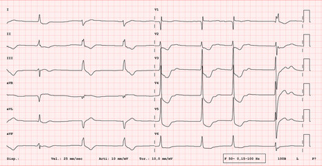 ECG Electrocardiogram Showing Digital Intoxication Pattern with Characteristic ST Segment Depression and Sagging Effect on 12-Lead Medical Diagnostic Chart