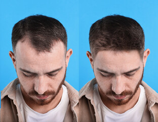 Man before and after hair treatment on blue background, collage