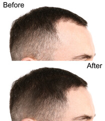 Man before and after hair treatment on white background, collage
