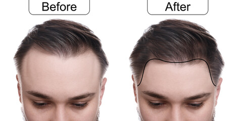 Man before and after hair treatment on white background, collage