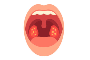 Fototapeta premium Human mouth illustration showing tonsils and throat anatomy inflamed tonsils