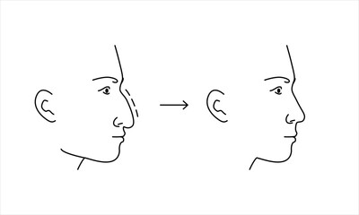 Outline vector illustration showing rhinoplasty of noce hump of a young man, face profile picture before and after.