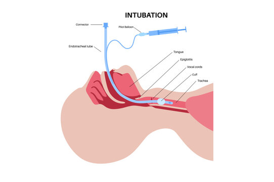 Intubation medical procedure