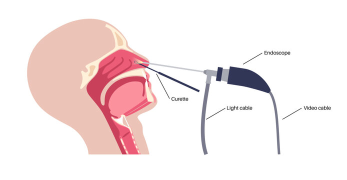 Nasal endoscopy poster