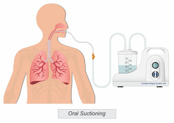 Oral suction is suction that is applied to removing mucous secretions.