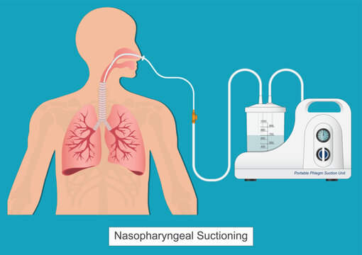 Nasogastric (NG) suctioning is the process