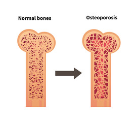 Anatomy of Osteoporosis Bone and Bone Health Illustration