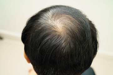 Bald head in man, hair loss treatment health problem.