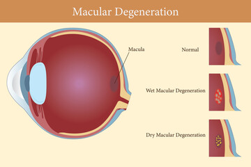 Illustration of human eye showing normal, wet, and dry macular degeneration conditions. eps 10