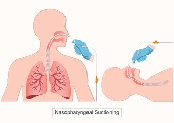 Nasopharyngeal suctioning is a medical procedure.