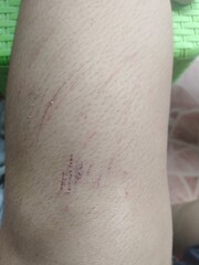 pregnant woman belly Abrasions from falling